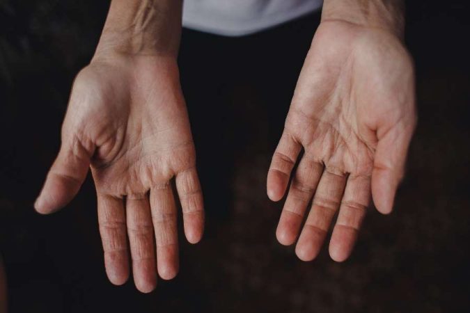 Vue de face de mains abîmées présentant une peau sèche et fatiguée.